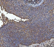 IHC staining of FFPE human squamous cell carcinoma of the penis tissue with NIT2 antibody. HIER: boil tissue sections in pH8 EDTA for 20 min and allow to cool before testing.