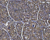 IHC staining of FFPE human liver cancer tissue with NIT2 antibody. HIER: boil tissue sections in pH8 EDTA for 20 min and allow to cool before testing.
