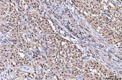 IHC staining of FFPE human bladder urothelial carcinoma tissue with NUB1 antibody. HIER: boil tissue sections in pH8 EDTA for 20 min and allow to cool before testing.