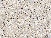 IHC staining of FFPE human adrenal adenoma tissue with NUB1 antibody. HIER: boil tissue sections in pH8 EDTA for 20 min and allow to cool before testing.