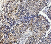 IHC staining of FFPE human ovarian cancer tissue with NUB1 antibody. HIER: boil tissue sections in pH8 EDTA for 20 min and allow to cool before testing.