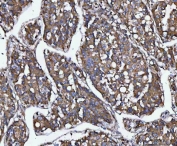 IHC staining of FFPE human liver cancer tissue with TANGO1 antibody. HIER: boil tissue sections in pH8 EDTA for 20 min and allow to cool before testing.