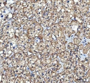 IHC staining of FFPE human adrenal adenoma tissue with MYCBP antibody. HIER: boil tissue sections in pH8 EDTA for 20 min and allow to cool before testing.
