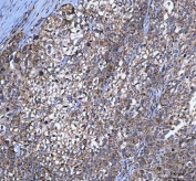 IHC staining of FFPE human bladder urothelial carcinoma tissue with MYCBP antibody. HIER: boil tissue sections in pH8 EDTA for 20 min and allow to cool before testing.
