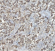 IHC staining of FFPE human testicular germ cell tumor tissue with MYCBP antibody. HIER: boil tissue sections in pH8 EDTA for 20 min and allow to cool before testing.