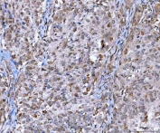 IHC staining of FFPE human bladder urothelial carcinoma tissue with MMS19 antibody. HIER: boil tissue sections in pH8 EDTA for 20 min and allow to cool before testing.