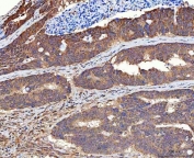 IHC staining of FFPE human colorectal adenocarcinoma tissue with MMS19 antibody. HIER: boil tissue sections in pH8 EDTA for 20 min and allow to cool before testing.