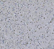 IHC staining of FFPE human glioblastoma tissue with Paraspeckle component 1 antibody. HIER: boil tissue sections in pH8 EDTA for 20 min and allow to cool before testing.