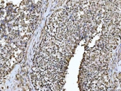 IHC staining of FFPE human ovarian serous adenocarcinoma tissue with Paraspeckle component 1 antibody. HIER: boil tissue sections in pH8 EDTA for 20 min and allow to cool before testing.
