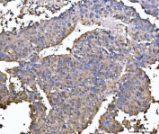 IHC staining of FFPE human liver cancer tissue with NUDT5 antibody. HIER: boil tissue sections in pH8 EDTA for 20 min and allow to cool before testing.