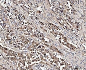 IHC staining of FFPE human lung cancer tissue with NUDT5 antibody. HIER: boil tissue sections in pH8 EDTA for 20 min and allow to cool before testing.