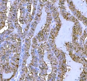IHC staining of FFPE human thyroid cancer tissue with LHX6 antibody. HIER: boil tissue sections in pH8 EDTA for 20 min and allow to cool before testing.