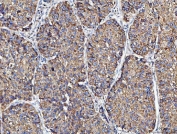 IHC staining of FFPE human liver cancer tissue with MOCS1 antibody. HIER: boil tissue sections in pH8 EDTA for 20 min and allow to cool before testing.