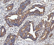 IHC staining of FFPE human colorectal adenocarcinoma tissue with MOCS1 antibody. HIER: boil tissue sections in pH8 EDTA for 20 min and allow to cool before testing.