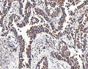 IHC staining of FFPE human breast cancer tissue with MOCS1 antibody. HIER: boil tissue sections in pH8 EDTA for 20 min and allow to cool before testing.