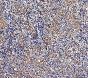 IHC staining of FFPE human testicular germ cell tumor tissue with MOCS1 antibody. HIER: boil tissue sections in pH8 EDTA for 20 min and allow to cool before testing.
