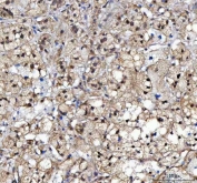 IHC staining of FFPE human adrenocortical adenoma tissue with c-Kit antibody. HIER: boil tissue sections in pH8 EDTA for 20 min and allow to cool before testing.