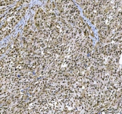 IHC staining of FFPE human bladder urothelial carcinoma tissue with c-Kit antibody. HIER: boil tissue sections in pH8 EDTA for 20 min and allow to cool before testing.