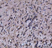IHC staining of FFPE human glioma tissue with Modulator of apoptosis 1 antibody. HIER: boil tissue sections in pH8 EDTA for 20 min and allow to cool before testing.