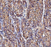 IHC staining of FFPE human liver cancer tissue with Modulator of apoptosis 1 antibody. HIER: boil tissue sections in pH8 EDTA for 20 min and allow to cool before testing.
