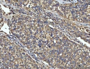IHC staining of FFPE human non-small cell lung cancer tissue with NPEPPS antibody. HIER: boil tissue sections in pH8 EDTA for 20 min and allow to cool before testing.