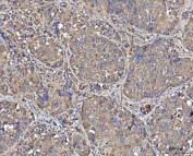 IHC staining of FFPE human liver cancer tissue with MECR antibody. HIER: boil tissue sections in pH8 EDTA for 20 min and allow to cool before testing.