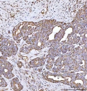 IHC staining of FFPE human ovarian cancer tissue with MECR antibody. HIER: boil tissue sections in pH8 EDTA for 20 min and allow to cool before testing.