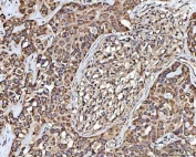 IHC staining of FFPE human parotid acinar cell carcinoma tissue with MECR antibody. HIER: boil tissue sections in pH8 EDTA for 20 min and allow to cool before testing.