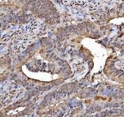 IHC staining of FFPE human colorectal adenocarcinoma tissue with NELF antibody. HIER: boil tissue sections in pH8 EDTA for 20 min and allow to cool before testing.