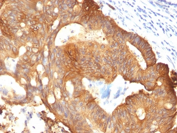 IHC: Formalin-fixed, paraffin-embedded colon carcinoma stained with Cytokeratin 8 antibody (B22.1).