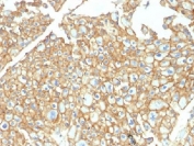 IHC testing of FFPE human renal cell carcinoma and EpCAM antibody. Required HIER: steam sections in pH6 citrate buffer for 10-20 min.