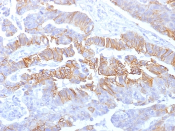 IHC testing of formalin-fixed, paraffin-embedded human colon carcinoma with recombinant E-Cadherin antibody (clone rCDH1/1525). Required HIER: boil tissue sections in pH 9 10mM Tris with 1mM EDTA for 10-20 min followed by cooling at RT for 20 min.~
