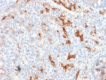 IHC testing of FFPE human melanoma tissue with recombinant p75NTR antibody. Required HIER: boil tissue sections in pH6, 10mM citrate buffer, for 10-20 min followed by cooling at RT for 20 min.~