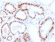 IHC testing of human breast carcinoma stained with ER alpha antibody (clone NR3Ga-2). Staining of formalin-fixed tissues requires boiling tissue sections in pH 9 10mM Tris with 1mM EDTA for 10-20 min followed by cooling at RT for 20 minutes.