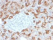 IHC testing of FFPE human pancreatic carcinoma with TROP2 antibody (clone TACSTD2/2153). Required HIER: boil tissue sections in pH 9 10mM Tris with 1mM EDTA for 10-20 min followed by cooling at RT for 20 min.