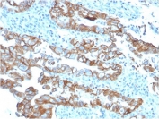 IHC testing of FFPE human colon carcinoma with TROP2 antibody (clone TACSTD2/2153). Required HIER: boil tissue sections in pH 9 10mM Tris with 1mM EDTA for 10-20 min followed by cooling at RT for 20 min.