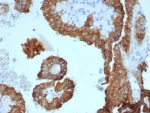 IHC staining of FFPE human kidney carcinoma tissue with Crystallin Alpha B antibody (clone CRYAB/4662). HIER: boil tissue sections in pH 9 10mM Tris with 1mM EDTA for 20 min and allow to cool before testing.