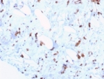 IHC staining of FFPE human liposarcoma tissue with STAT6 antibody (clone STAT6/7774R). HIER: boil tissue sections in pH 9 10mM Tris with 1mM EDTA for 20 min and allow to cool before testing.