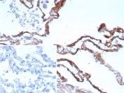 IHC staining of FFPE human lung tissue with recombinant POSTN antibody (clone rPOSTN/8522). Inset: PBS used in place of primary Ab (secondary Ab negative control). HIER: boil tissue sections in pH 9 10mM Tris with 1mM EDTA for 20 min and allow to cool before testing.