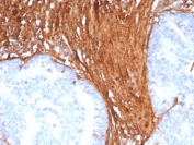 IHC staining of FFPE human colon tissue with recombinant Periostin antibody (clone POSTN/8523R). HIER: boil tissue sections in pH 9 10mM Tris with 1mM EDTA for 20 min and allow to cool before testing.
