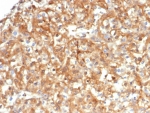 IHC staining of FFPE human kidney carcinoma tissue with Alpha-1-Antitrypsin antibody (clone AAT/4609). HIER: boil tissue sections in pH 9 10mM Tris with 1mM EDTA for 20 min and allow to cool before testing.