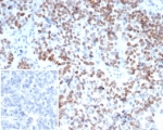 IHC staining of FFPE human ovarian carcinoma tissue with MEIS2 antibody (clone PCRP-MEIS2-2B3). Inset: PBS used in place of primary Ab (secondary Ab negative control). HIER: boil tissue sections in pH 9 10mM Tris with 1mM EDTA for 20 min and allow to cool before testing.