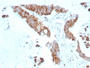 IHC staining of FFPE human colon carcinoma tissue with recombinant CD269 antibody (clone rCD269/8507). HIER: boil tissue sections in pH 9 10mM Tris with 1mM EDTA for 20 min and allow to cool before testing.