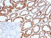 IHC staining of FFPE human gastric carcinoma tissue with TNFRSF17 antibody (clone BCMA/7253). Inset: PBS used in place of primary Ab (secondary Ab negative control). HIER: boil tissue sections in pH 9 10mM Tris with 1mM EDTA for 20 min and allow to cool before testing.