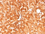 IHC staining of FFPE human hepatocellular carcinoma tissue with Haptoglobin antibody (clone HP/4813). HIER: boil tissue sections in pH 9 10mM Tris with 1mM EDTA for 20 min and allow to cool before testing.
