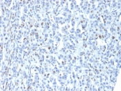 IHC staining of FFPE human tumor tissue (unknown origin) with Zinc finger protein 232 antibody (clone PCRP-ZNF232-1D5). HIER: boil tissue sections in pH 9 10mM Tris with 1mM EDTA for 20 min and allow to cool before testing.