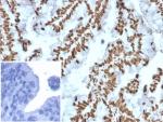 IHC staining of FFPE human prostate carcinoma tissue with ZNF690 / ZSCAN29 antibody (clone PCRP-ZNF846-1E12). Inset: PBS used in place of primary Ab (secondary Ab negative control). HIER: boil tissue sections in pH 9 10mM Tris with 1mM EDTA for 20 min and allow to cool before testing.