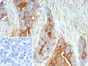 IHC staining of FFPE human ovarian cancer tissue with Mucin 1 antibody (clone MUC1/7797R). Inset: PBS used in place of primary Ab (secondary Ab negative control). HIER: boil tissue sections in pH 9 10mM Tris with 1mM EDTA for 20 min and allow to cool before testing.
