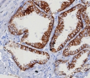 IHC staining of FFPE human prostate carcinoma tissue with EpCAM antibody (clone EGP40/8130R). HIER: boil tissue sections in pH 9 10mM Tris with 1mM EDTA for 20 min and allow to cool before testing.