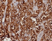 IHC staining of FFPE human mammary carcinoma tissue with EpCAM antibody (clone EGP40/8191R). HIER: boil tissue sections in pH 9 10mM Tris with 1mM EDTA for 20 min and allow to cool before testing.